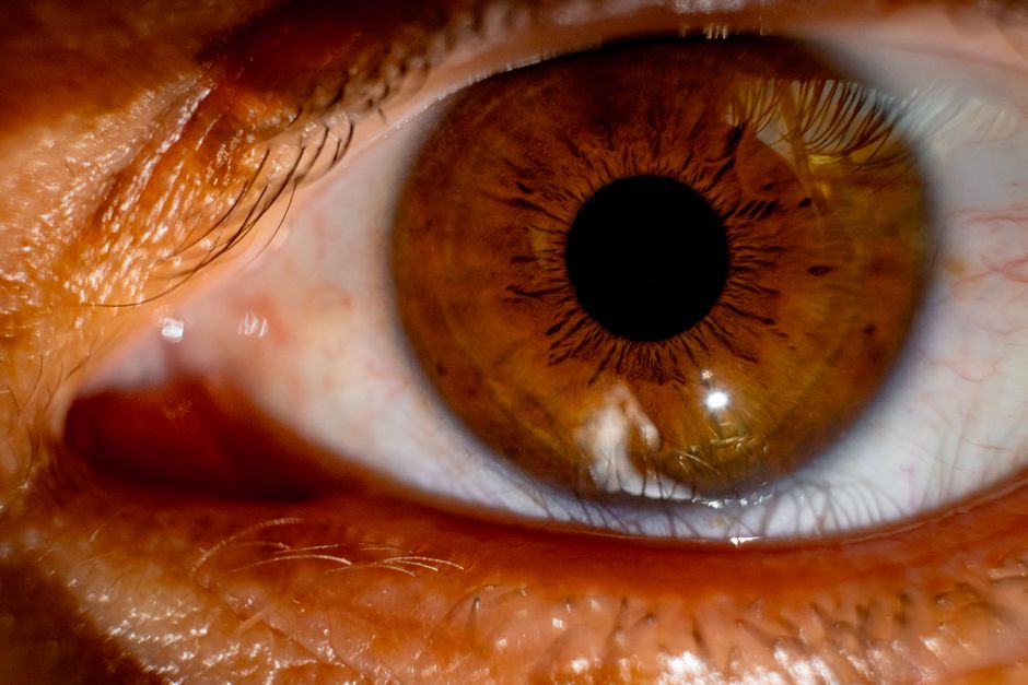 Fuchs endothelial dystrophy evaluation